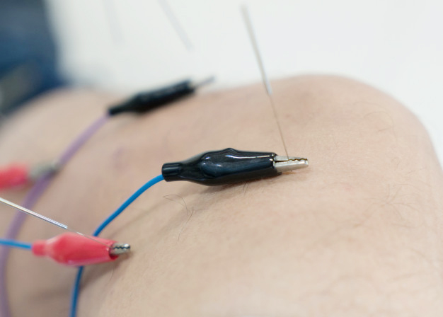Using Electronic Stimulation with Acpuncture