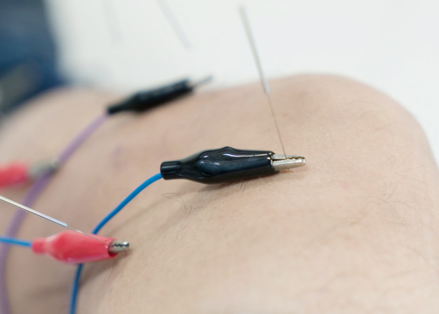 Electrical Stimulation of Acupuncture Needles