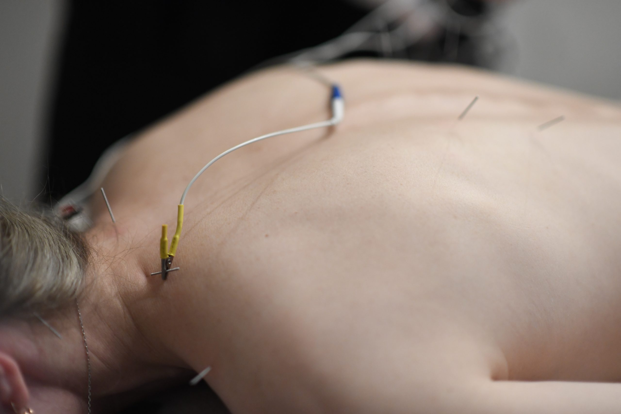 Patient with electro acupuncture needles in back